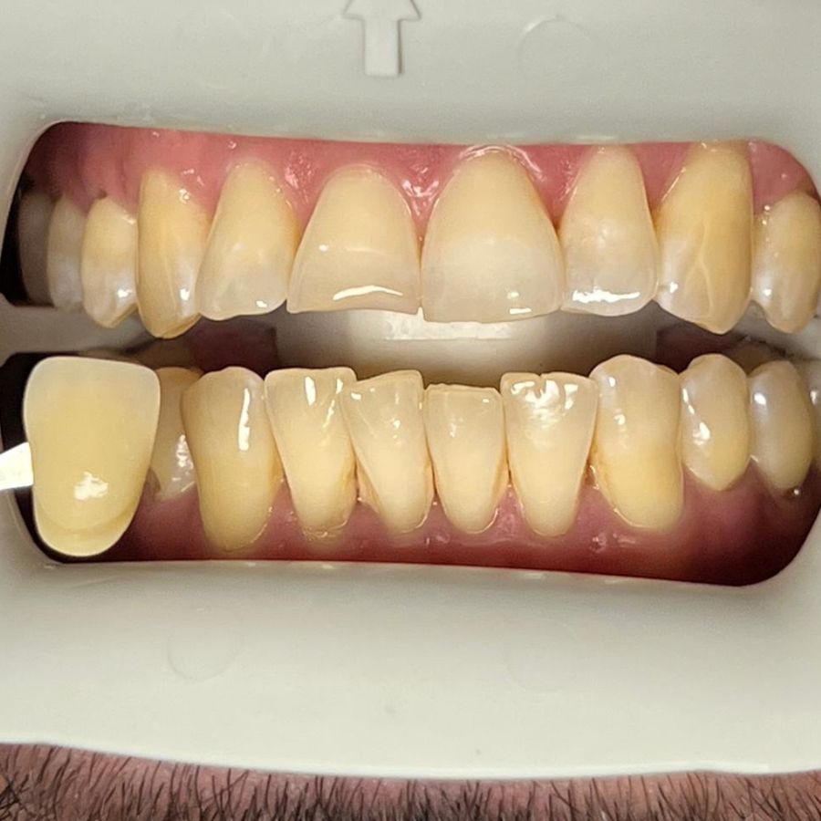 Teeth whitening: before