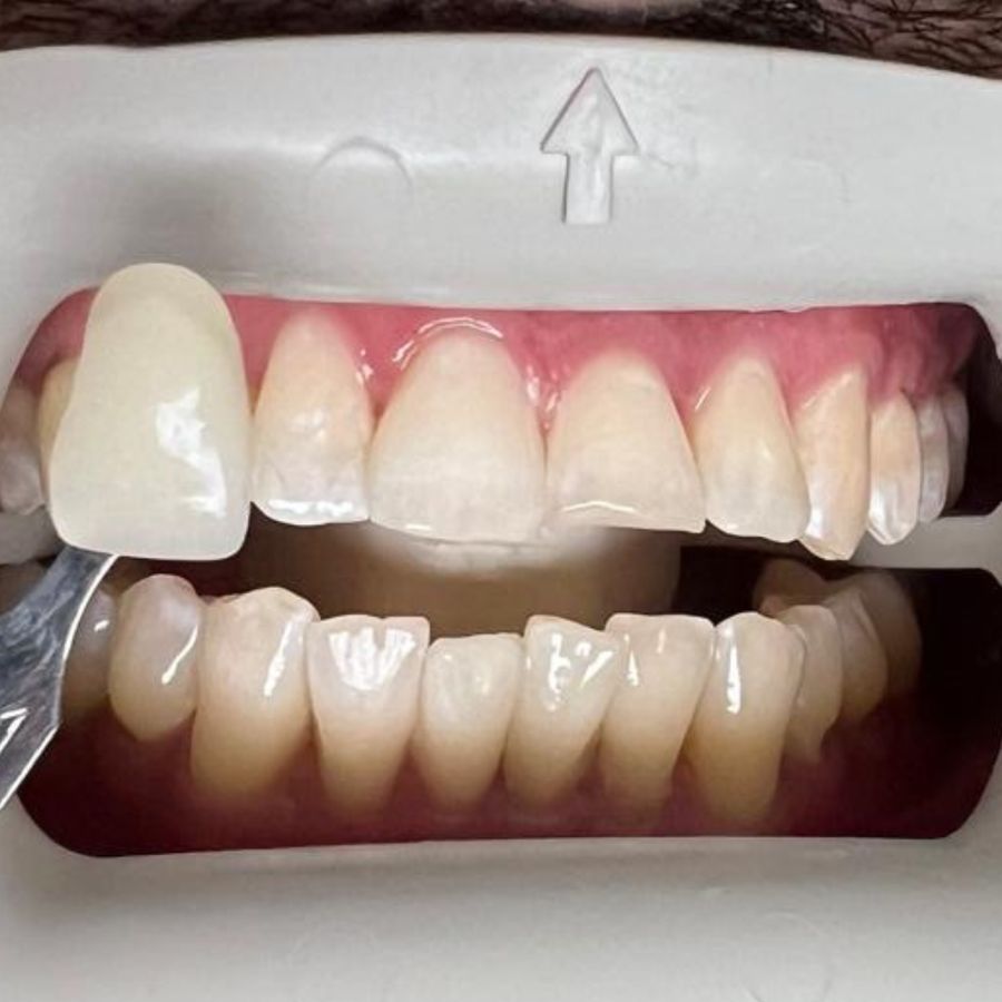 Teeth whitening: after
