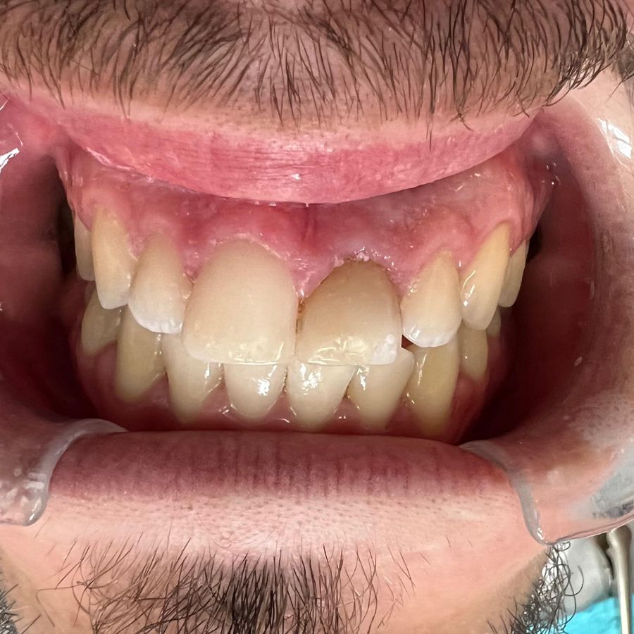 Upper anterior crown: before