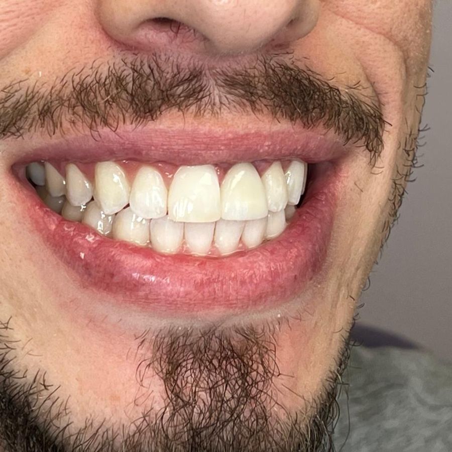 Upper anterior crown: after