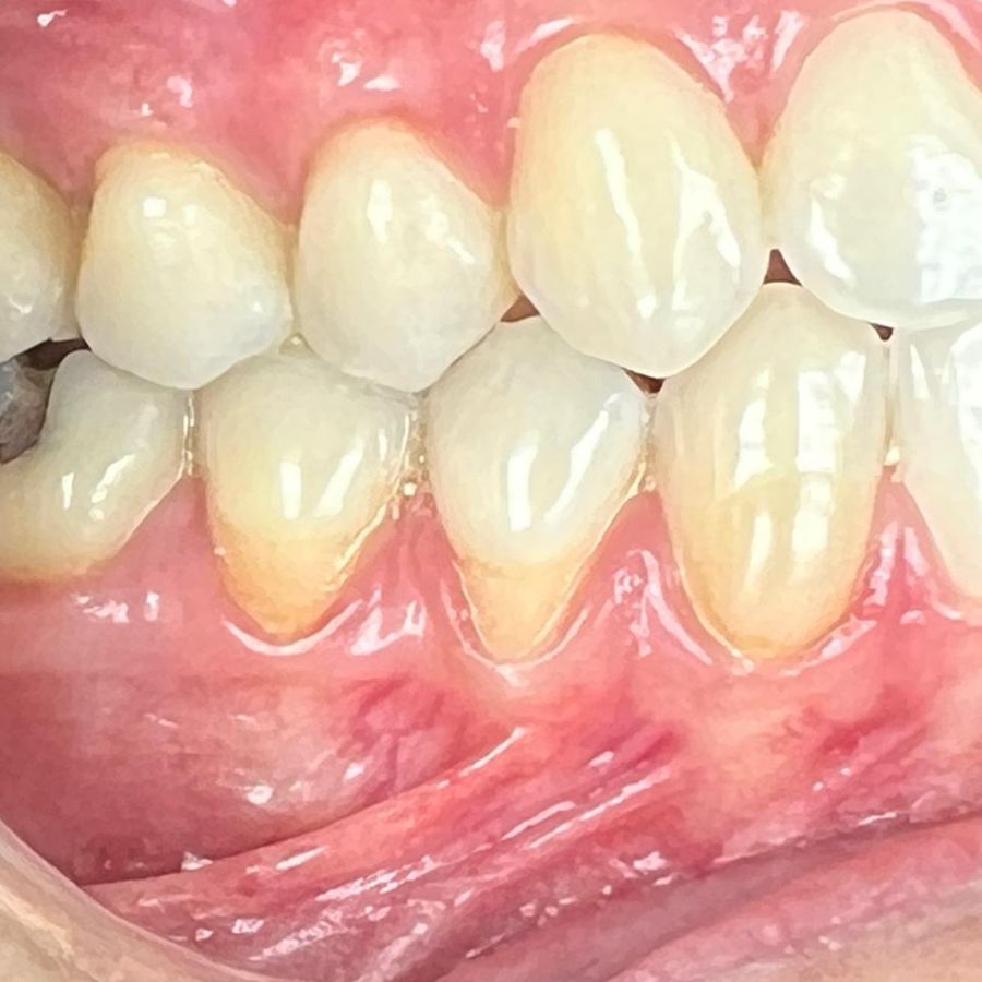 Gingival graft: before