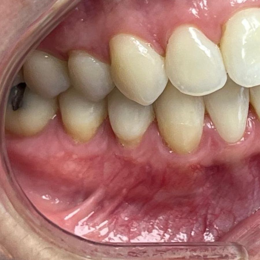 Gingival graft: after